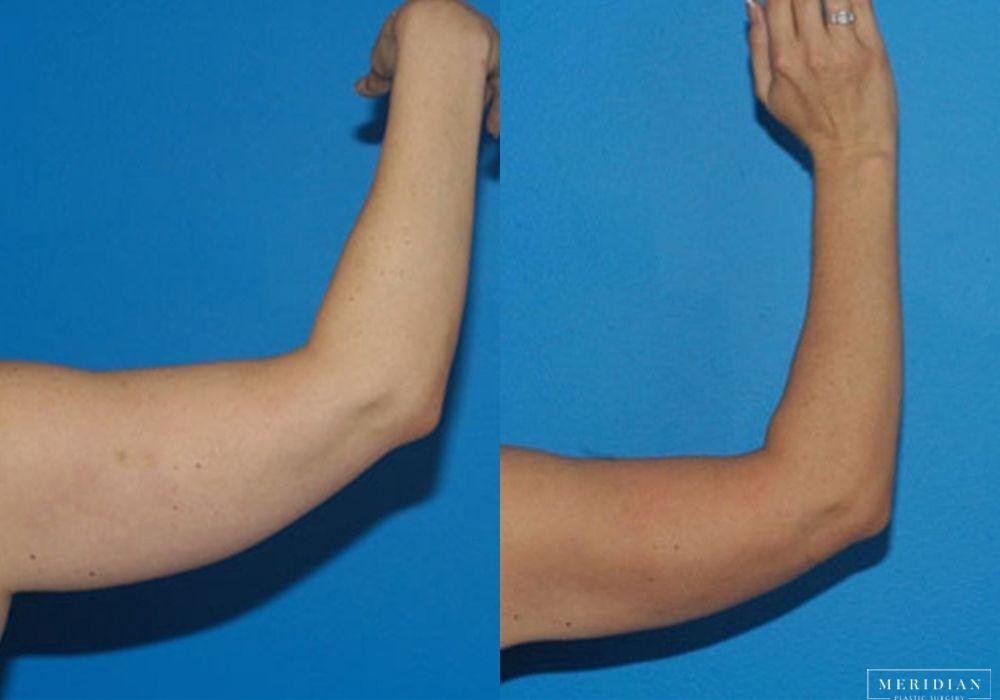 Body Contouring - Thumbnail 2