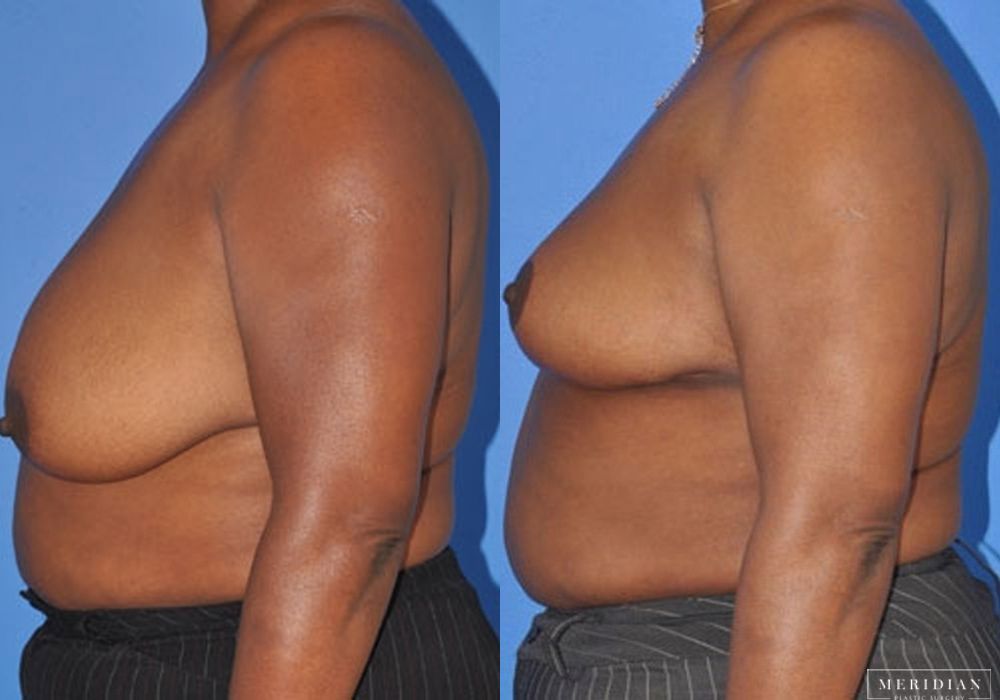 Breast Reduction - Thumbnail 2
