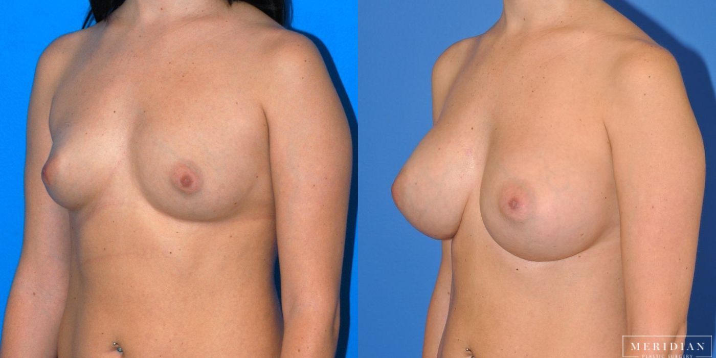 Breast Augmentation - Thumbnail 3