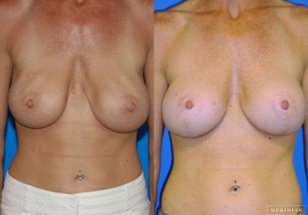 Body Contouring - Case 7982