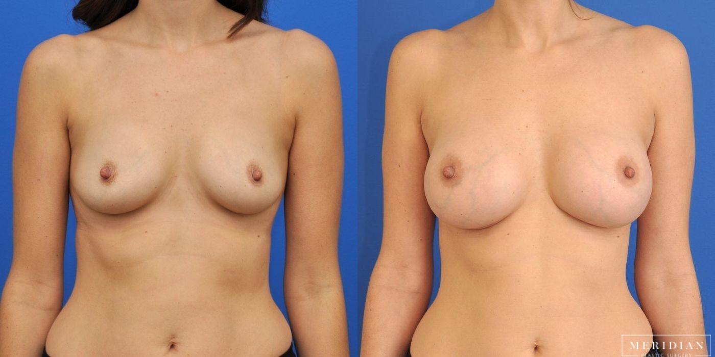 Breast Augmentation - Case 8051