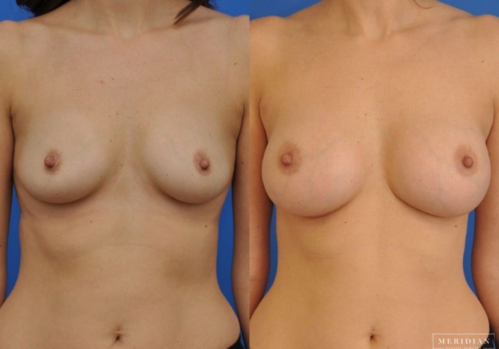 Breast Augmentation - Case 8043