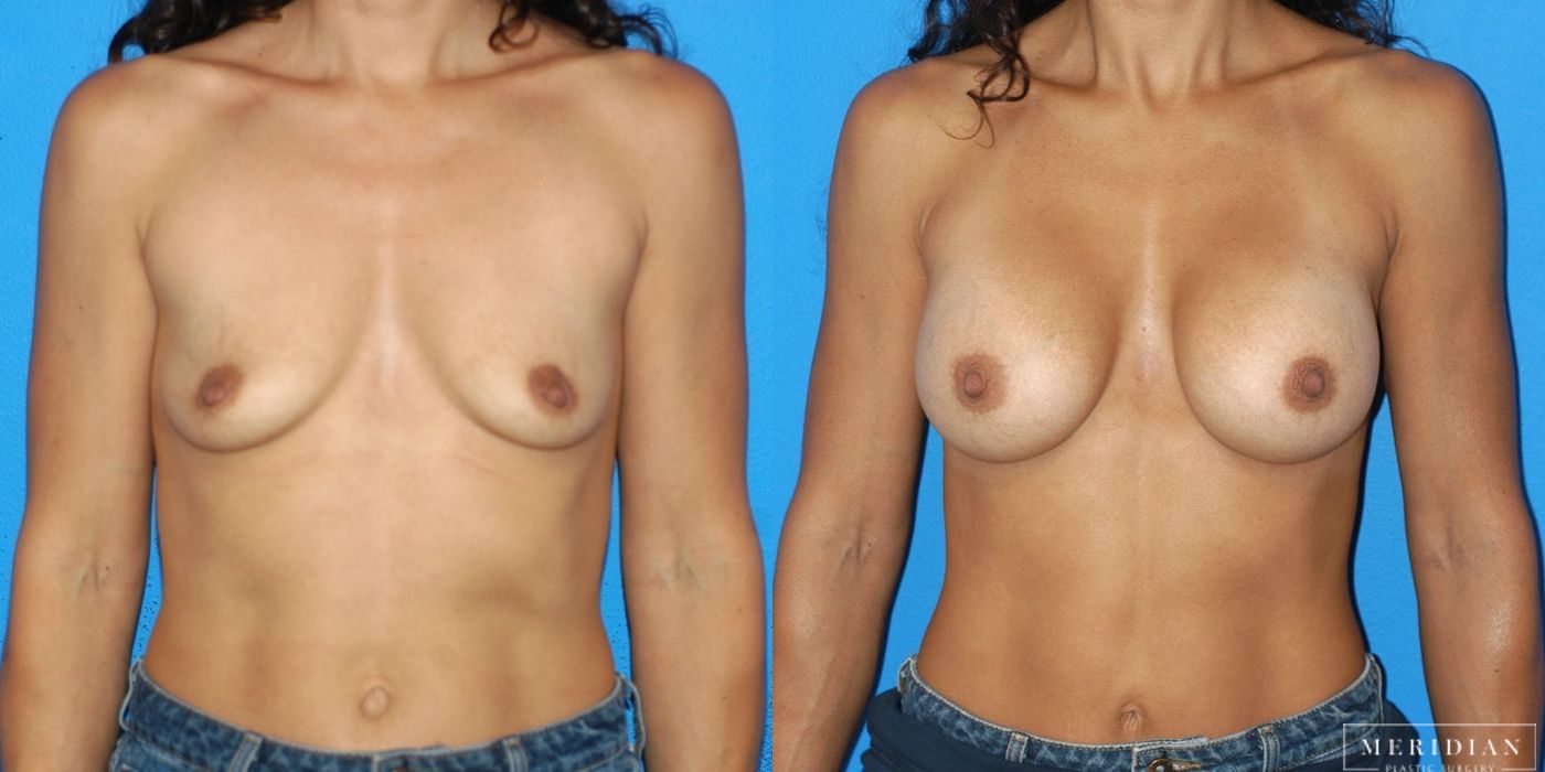 Breast Augmentation - Case 8049