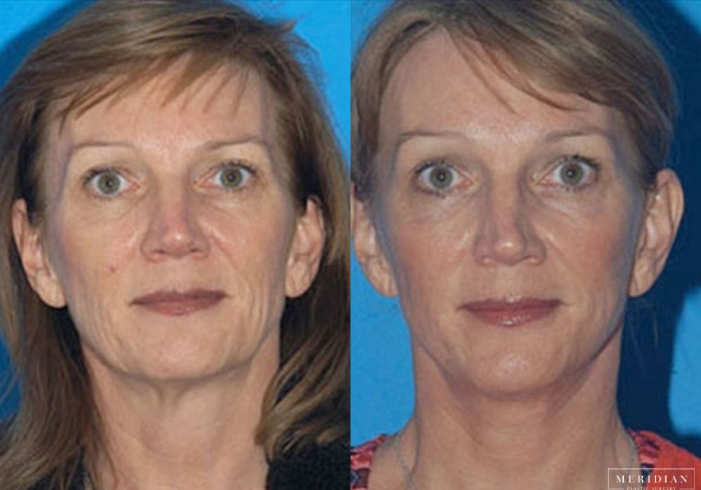 Brow Lift - Case 7913