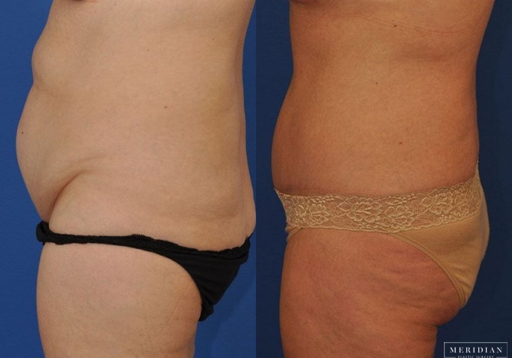 Tummy Tuck - Thumbnail 2