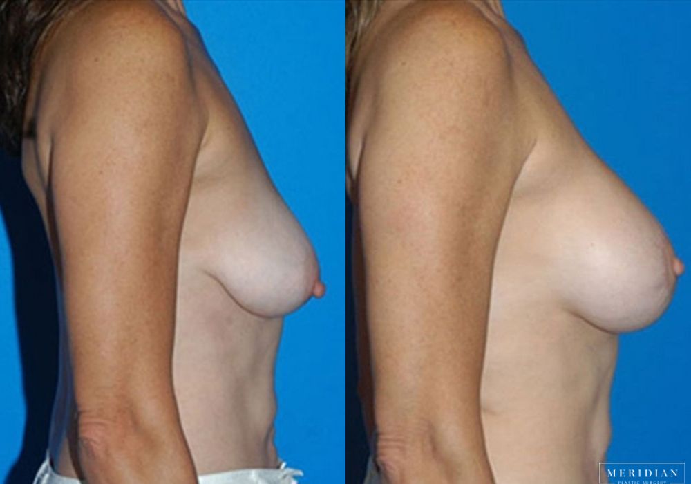 Body Contouring - Thumbnail 2