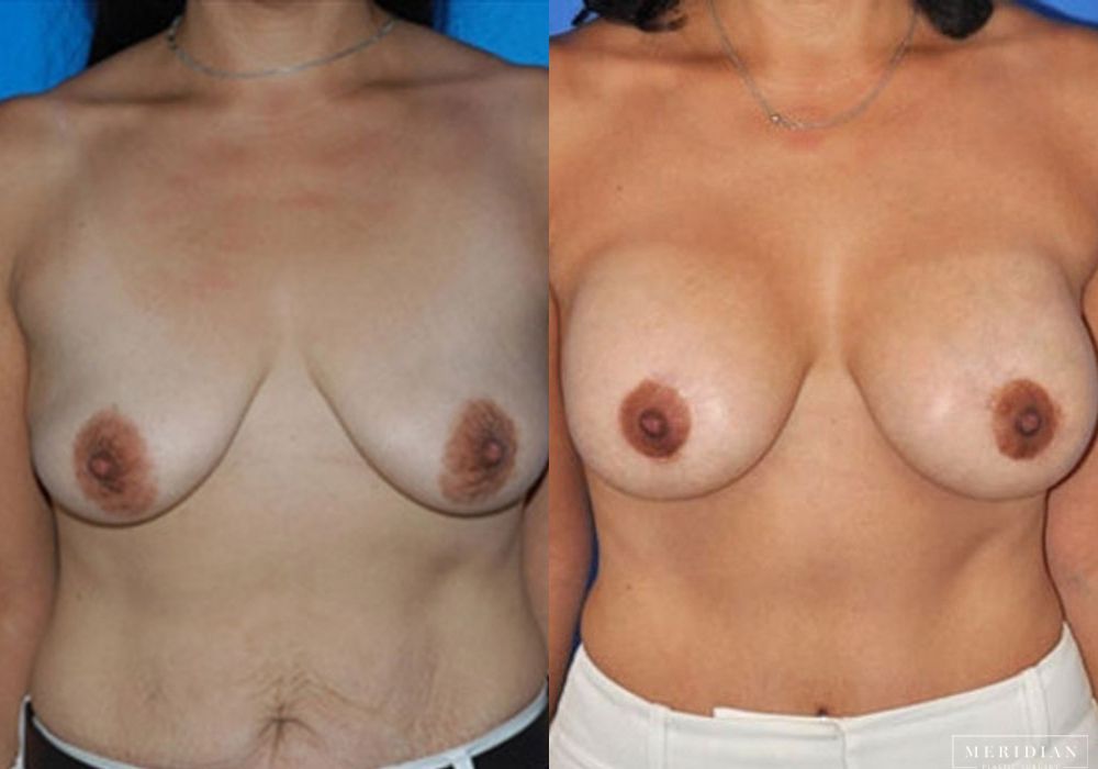 Breast Lift - Case 7869