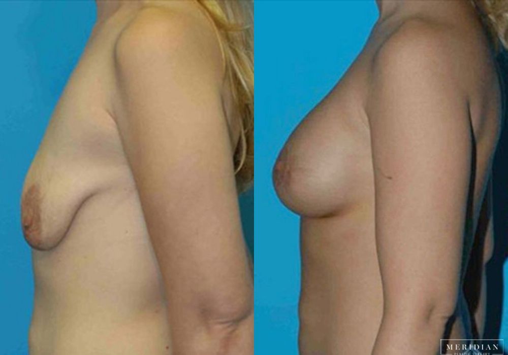 Breast Lift - Thumbnail 2