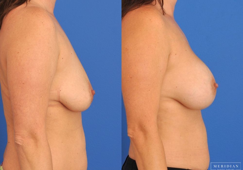 Breast Augmentation - Thumbnail 3