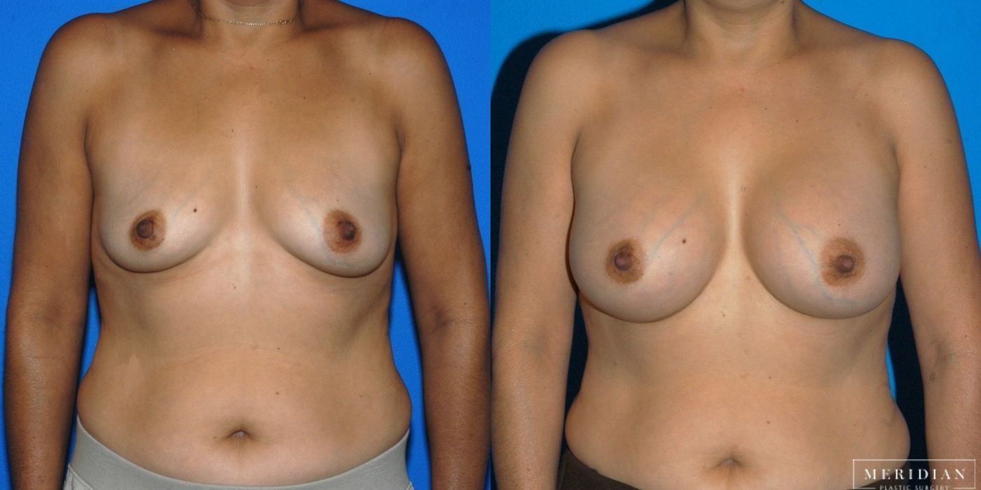 Before and after procedure result