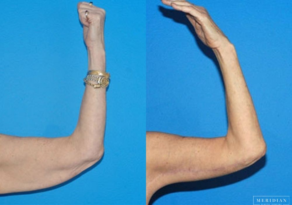 Body Contouring - Case 7975