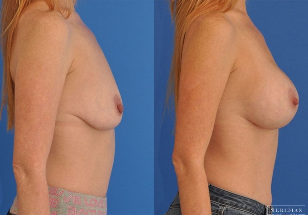 Breast Augmentation - Thumbnail 2