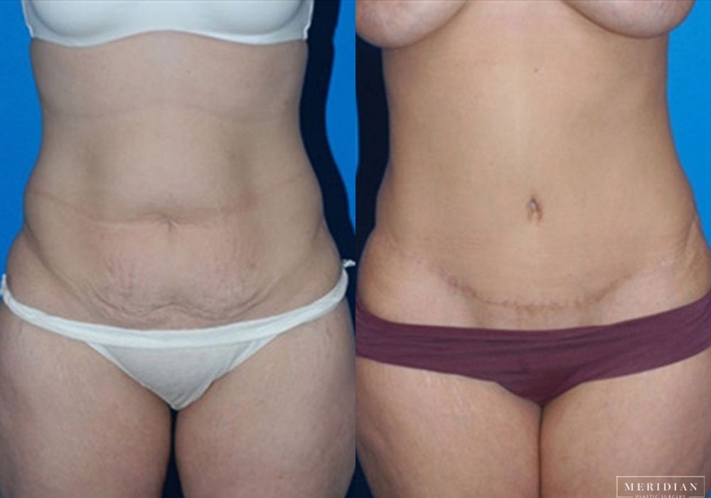 Before and after procedure result