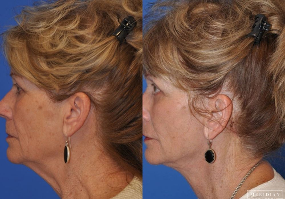 Neck Lift - Thumbnail 3
