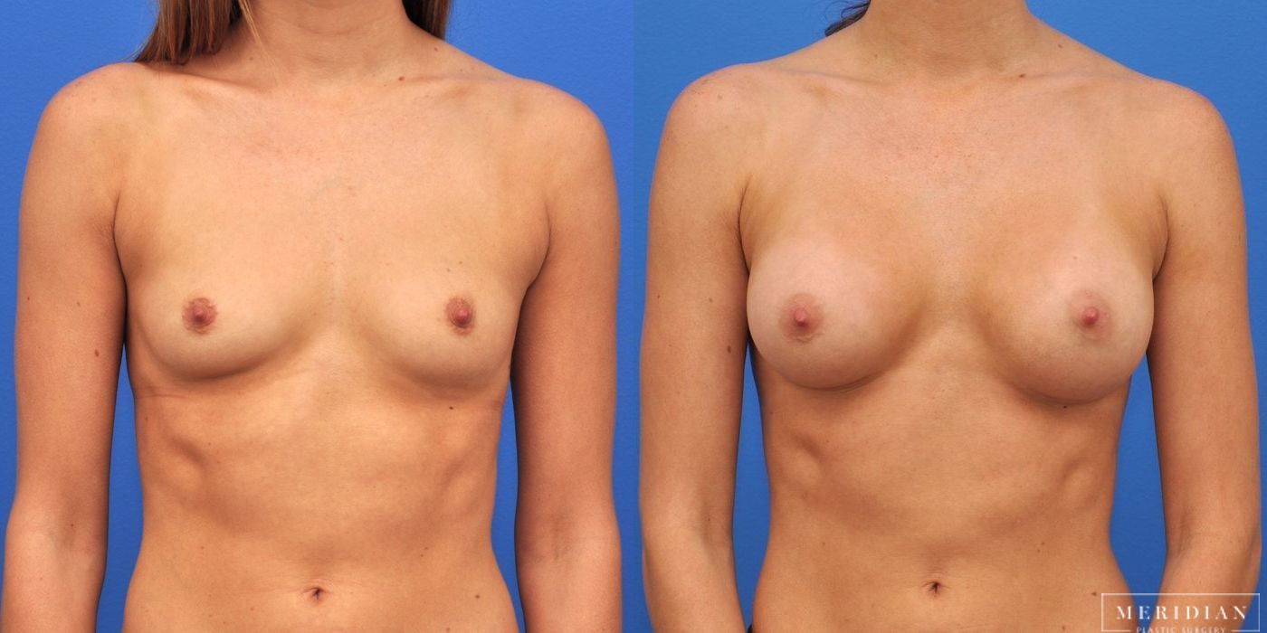 Breast Augmentation - Case 8022