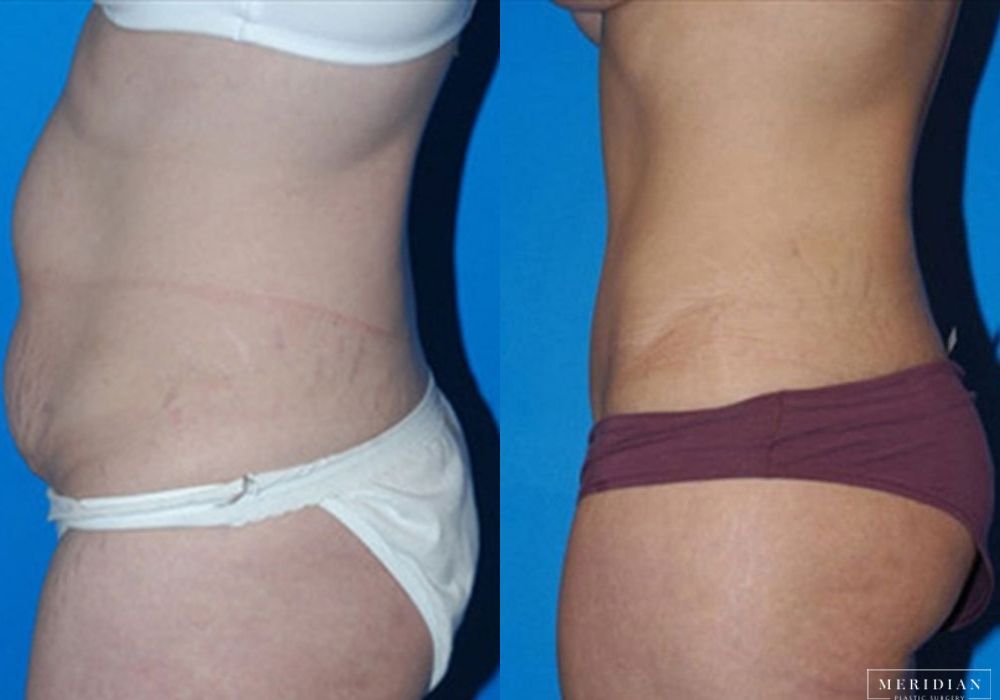 Body Contouring - Thumbnail 2