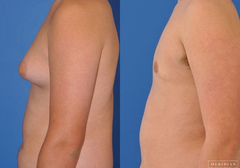 Gynecomastia - Thumbnail 2
