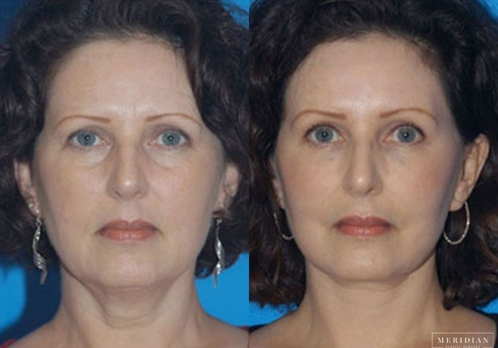 Brow Lift - Case 7912
