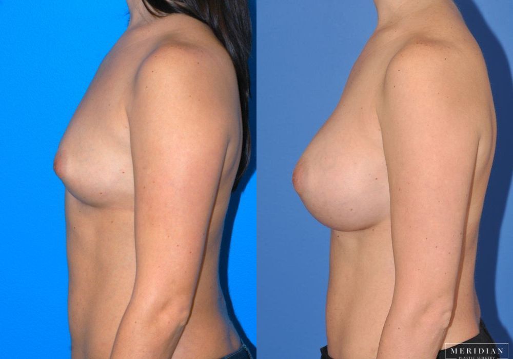 Breast Augmentation - Thumbnail 4