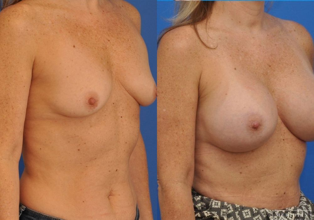 Breast Augmentation - Thumbnail 3