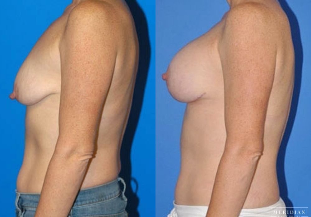 Breast Lift - Thumbnail 2
