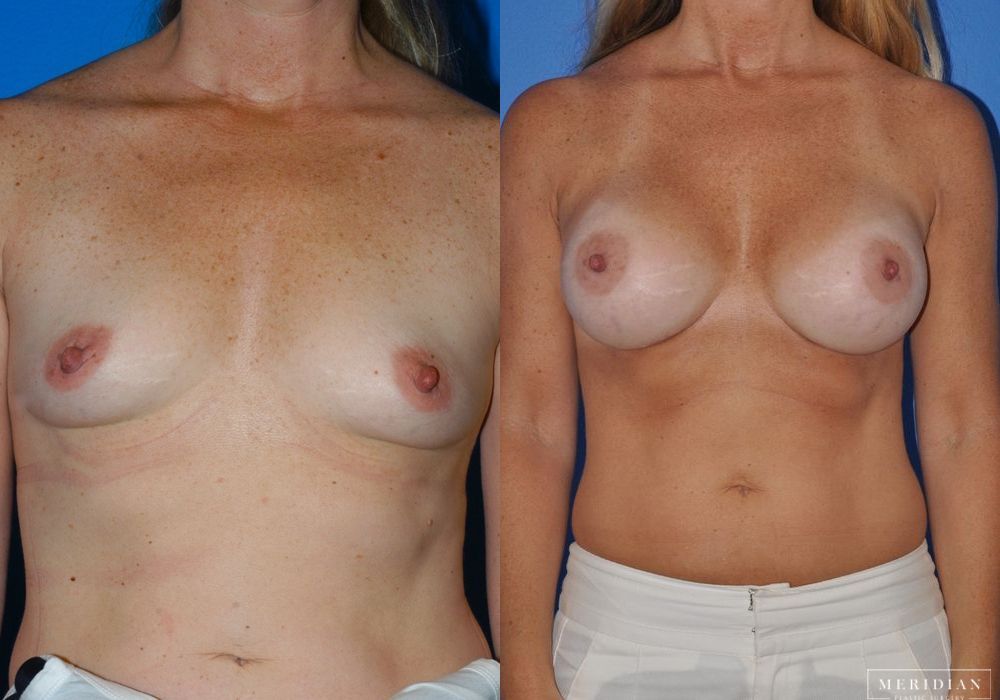Breast Augmentation - Case 8054