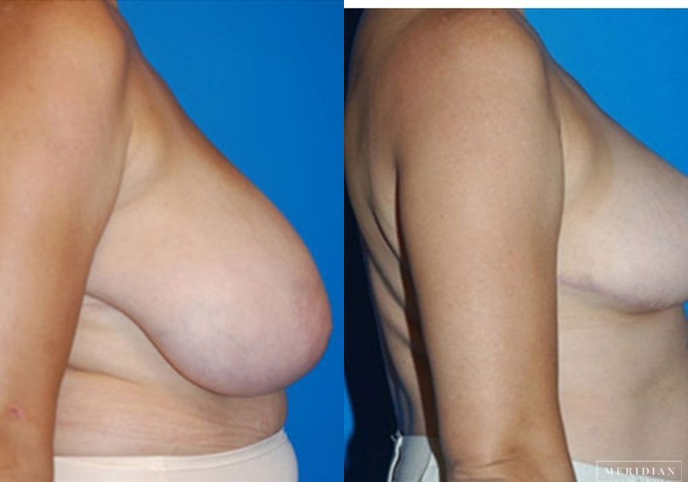 Breast Reduction - Thumbnail 2