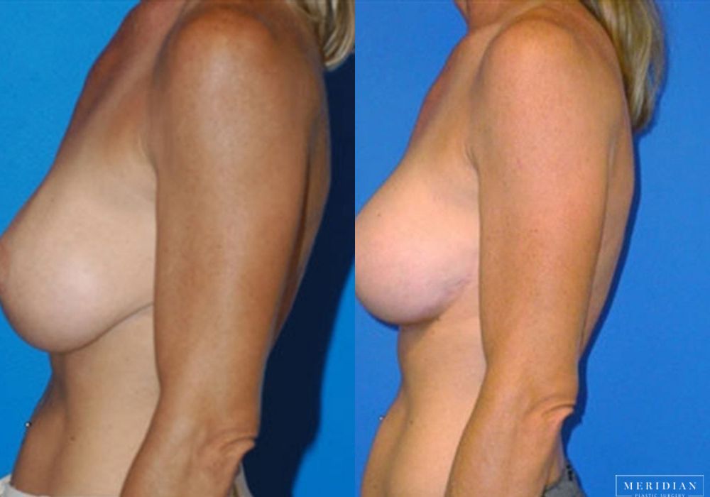 Body Contouring - Thumbnail 2