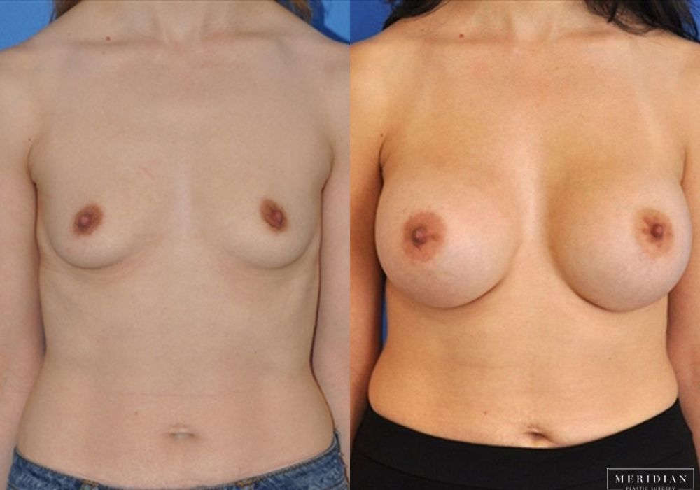 Breast Augmentation - Case 8036