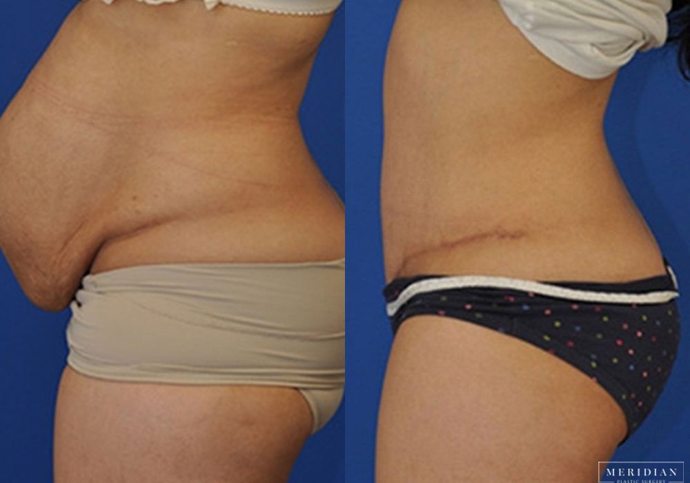 Tummy Tuck - Thumbnail 3