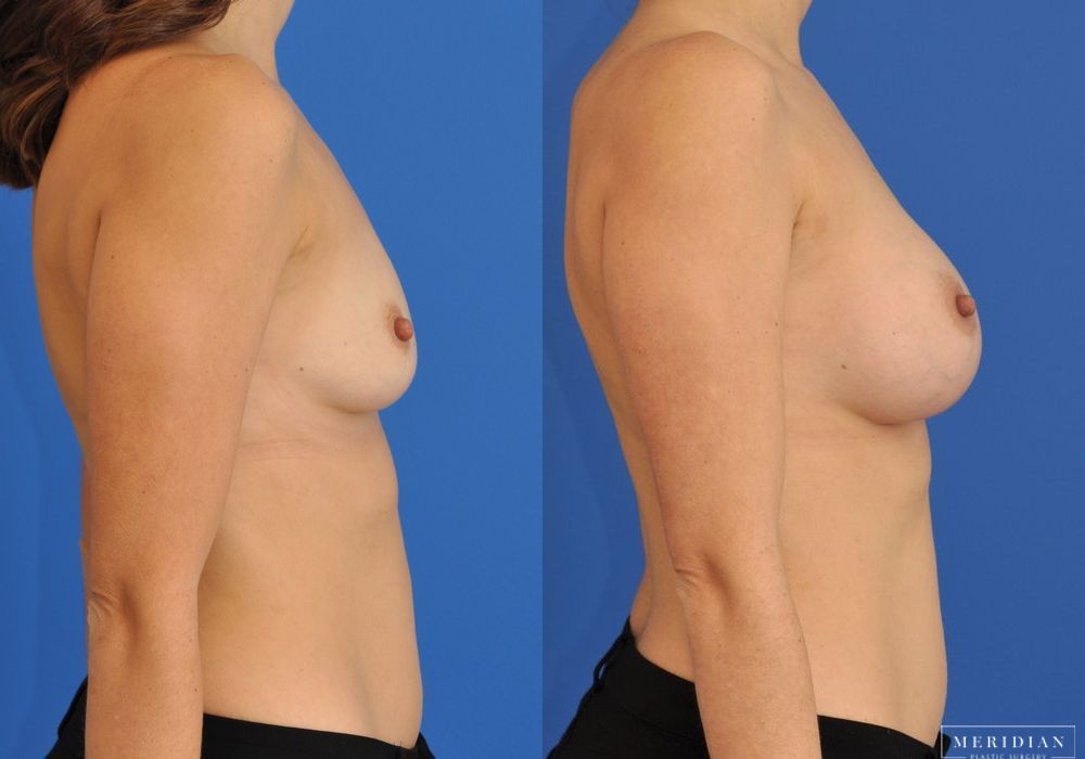 Breast Augmentation - Thumbnail 2