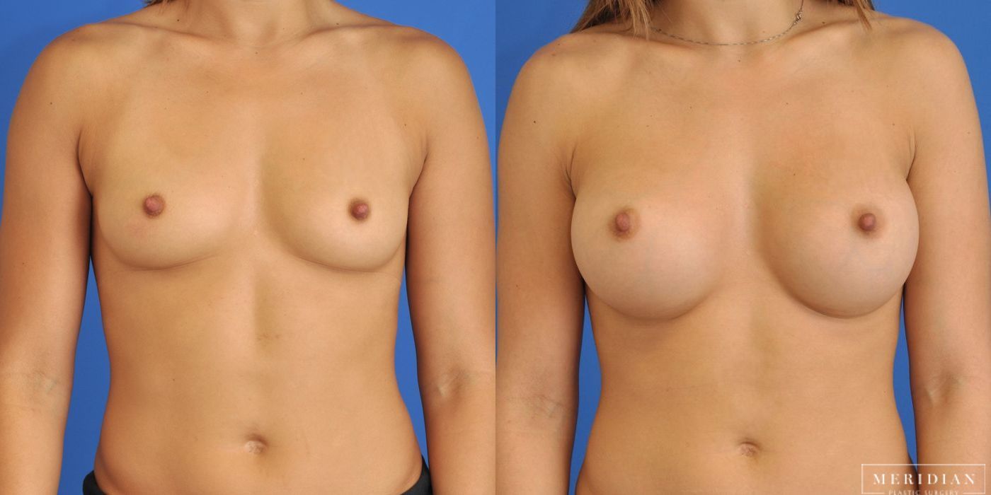 Before and after procedure result