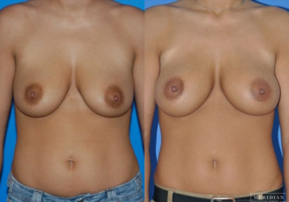 Breast Augmentation - Case 8035