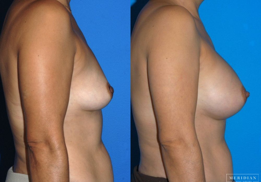 Breast Augmentation - Thumbnail 2