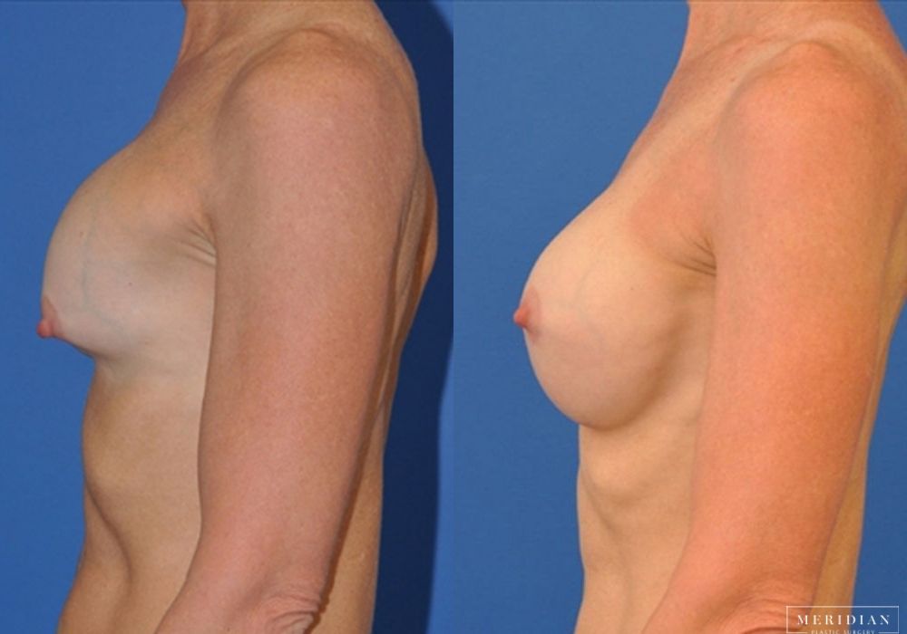 Breast Revision - Thumbnail 2