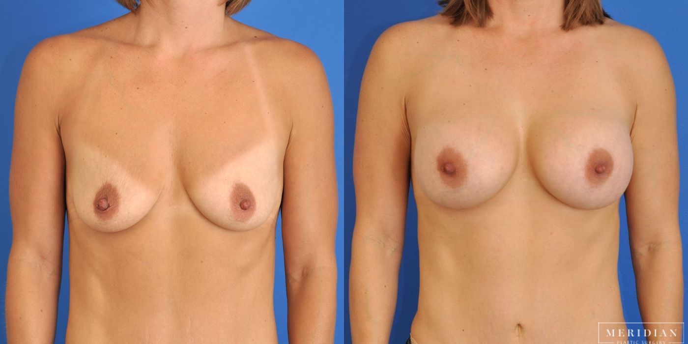 Breast Augmentation - Thumbnail 2