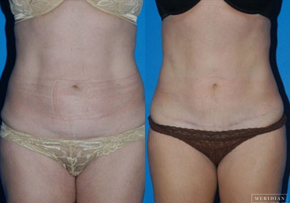 Tummy Tuck - Case 7996