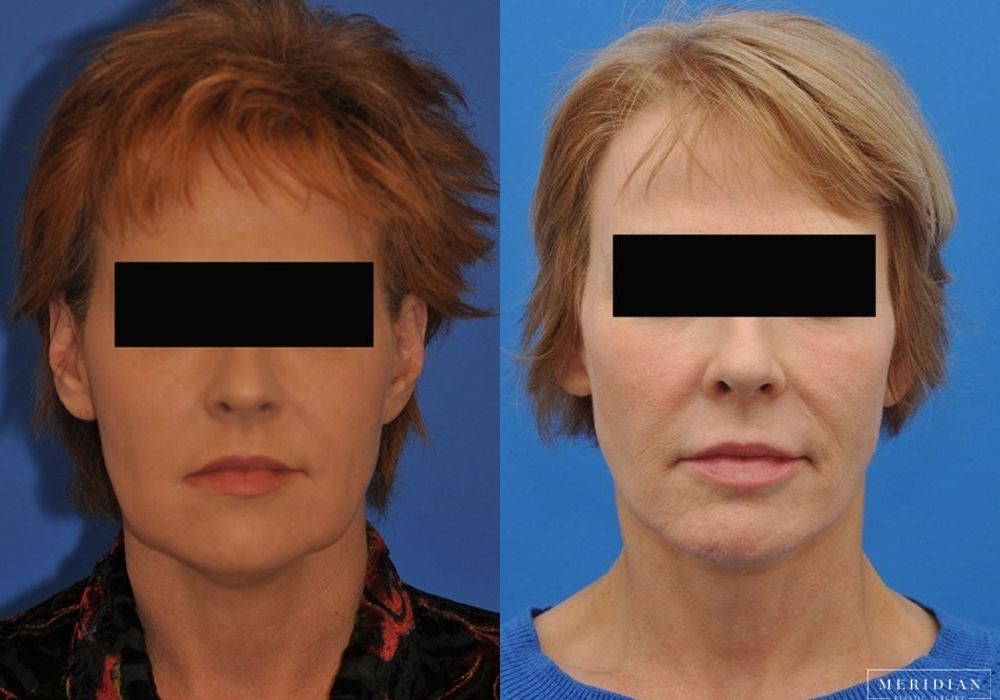 Facelift - Thumbnail 3