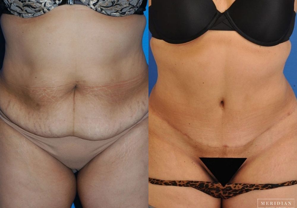 Tummy Tuck - Case 8001
