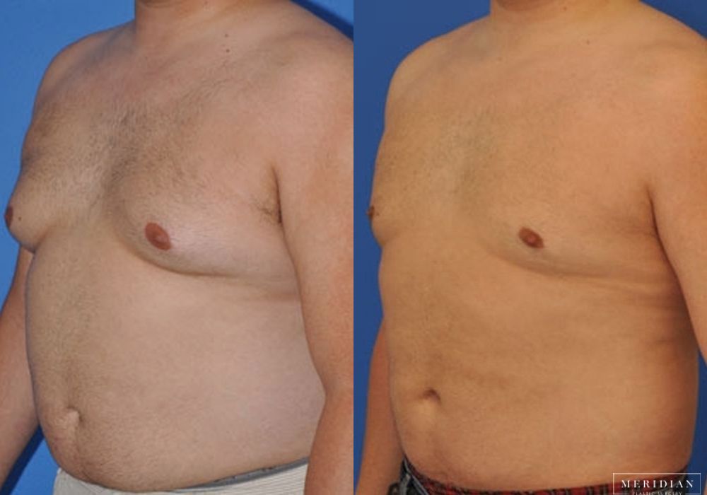 Gynecomastia - Thumbnail 2
