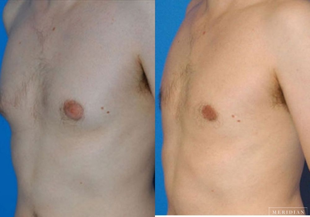 Gynecomastia - Case 7904