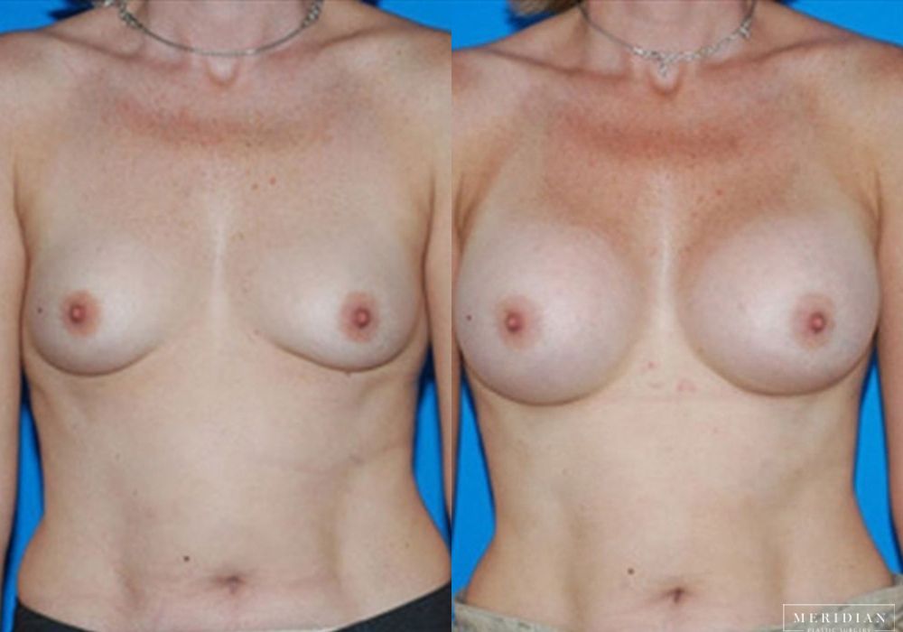 Breast Augmentation - Case 8038