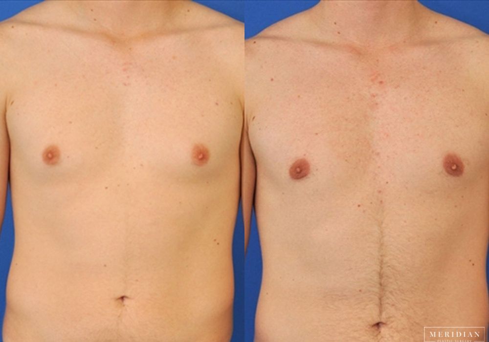 Gynecomastia - Case 7901