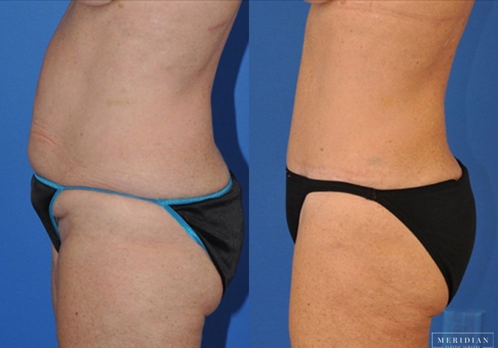 Tummy Tuck - Thumbnail 2