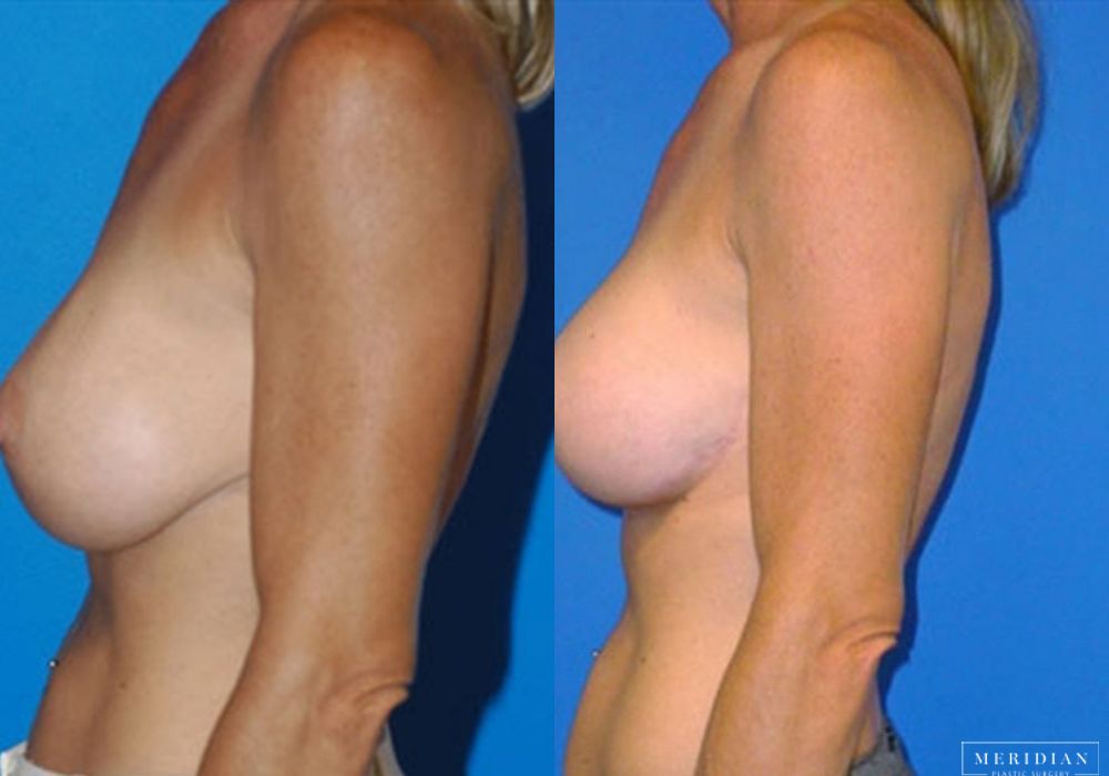 Breast Lift - Thumbnail 2