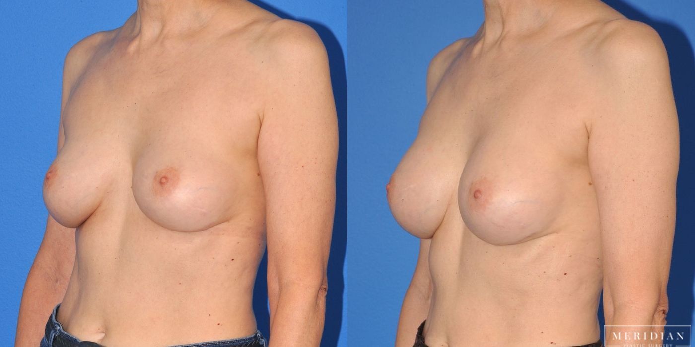 Breast Augmentation - Thumbnail 4