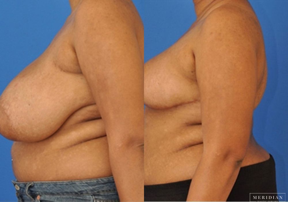 Breast Reduction - Thumbnail 2
