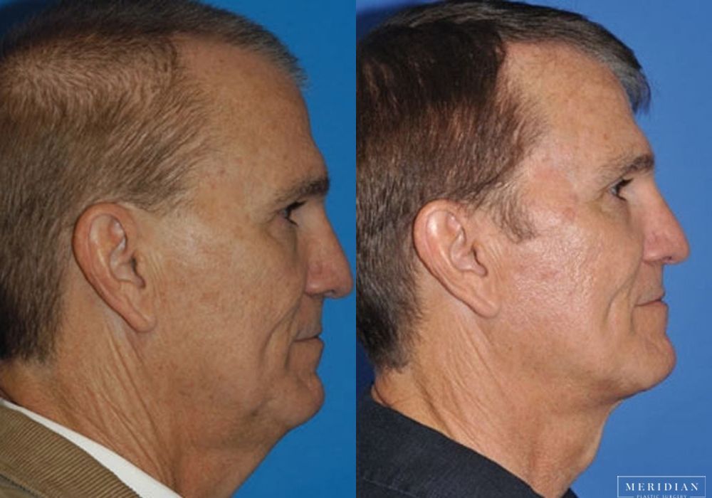 Facelift - Thumbnail 2