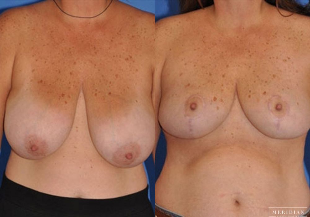 Breast Reduction - Case 7881