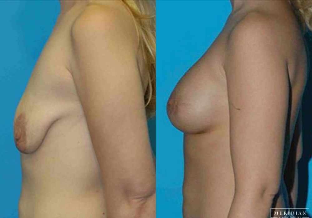 Body Contouring - Thumbnail 2